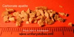 033-kidney-stone-nyresten-Carbonate-Apatite-RIRS-Kim-Hovgaard-Andreassen
