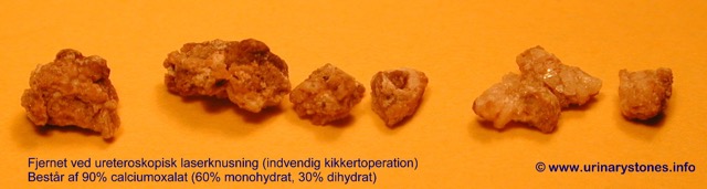 Nyresten (calciumoxalat) fra URSL