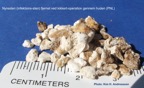 080-Kidney-stone-nyresten-PCNL-Kim-Hovgaard-Andreassen