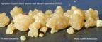 095a-kidney-stone-nyresten-cystine-RIRS-Kim-Hovgaard-Andreassen